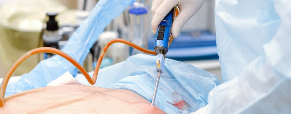 General Anesthesia Image